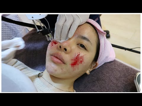ACNE AND PORE REDUCING TREATMENT😱