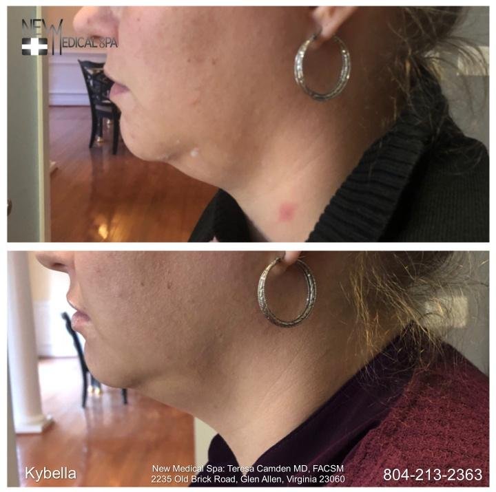 Dr. Teresa Camden’s New Medical Spa Is Offering Kybella Treatments For Getting Rid Of A Double Chin – Press Release