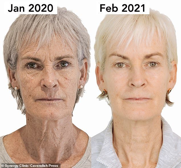 Game, set and match: Judy Murray, 61, used a non-surgical facelift treatment for this transformation after being teased by her sons