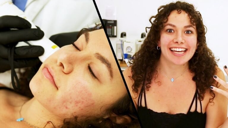 I Got Rid Of My Acne Scars With Laser Treatment
