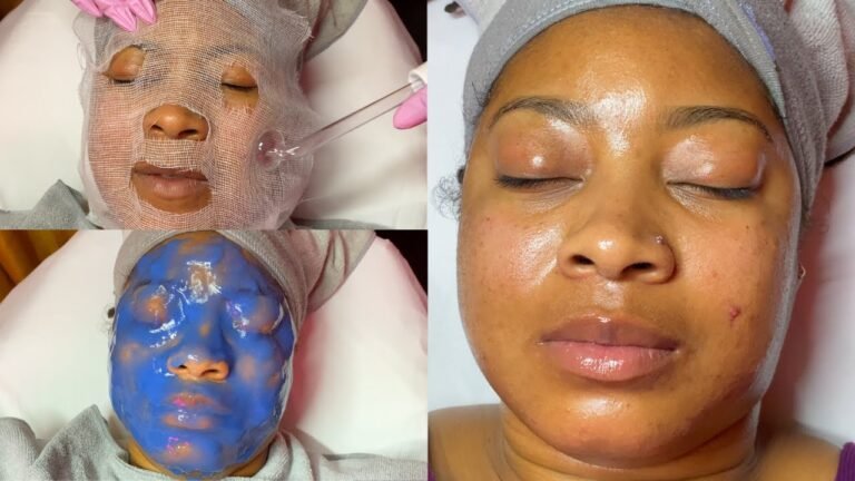 Severe Acne & Hyperpigmentation Facial Treatment | LiaLeigh
