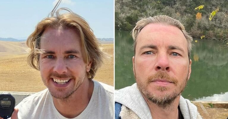 Did Dax Shepard Get Plastic Surgery? Experts Discuss His ‘Fresh’ Look