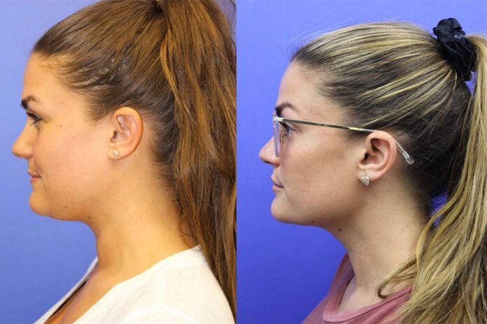 Brittany Cartwright Gets Rid of Double Chin with Kybella Injections, No Surgery