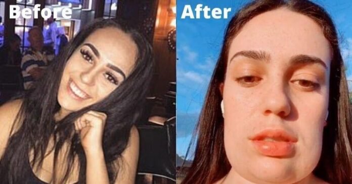 Girl's Face Turns Rectangular After Cosmetic Procedure
