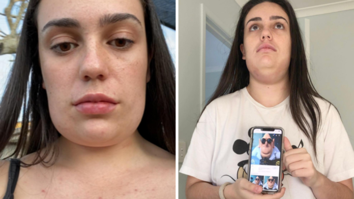 Gold Coast woman who got 'square head' after Kybella fat dissolving treatment shares transformation photos