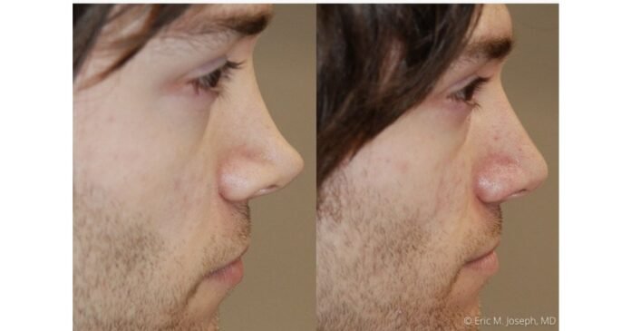 How To Know If A Permanent Non-Surgical Nose Job Is Too Good To Be True by Eric M. Joseph, M.D.