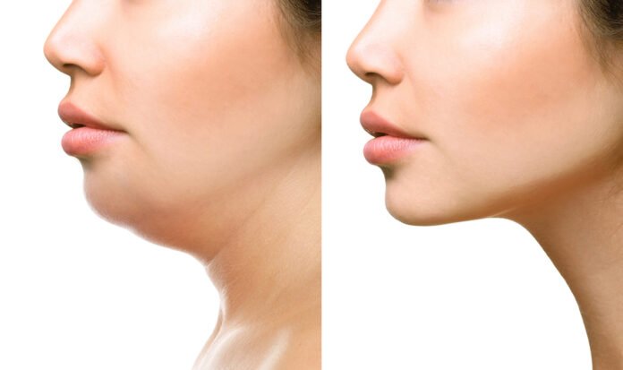Kybella Versus Surgery For Chin And Neck Fat: What Are Options?