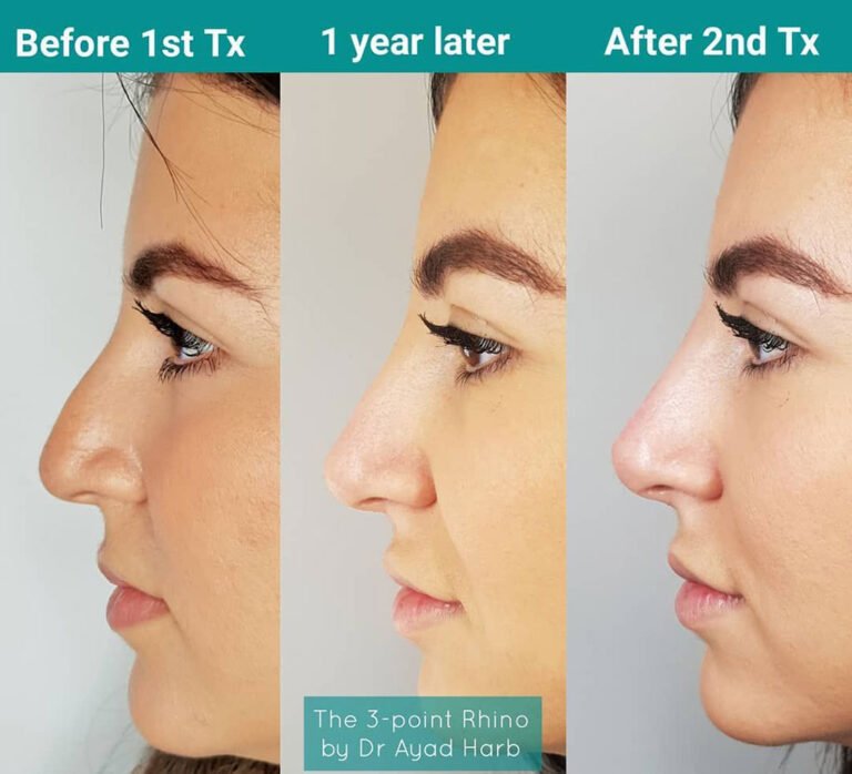 Liquid Rhinoplasty Offers a Non-Surgical Cosmetic Alternative – Surgical Techniques