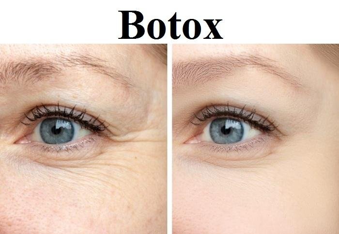 Botox Market Evenly Poised To Reach A Market Value of US$ By Share,