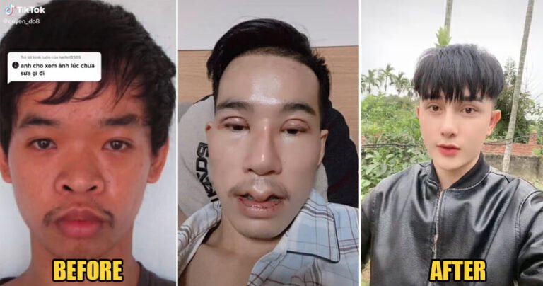 Vietnamese Man Undergoes 9 Plastic Surgeries After He Was Laughed At During Job Interview