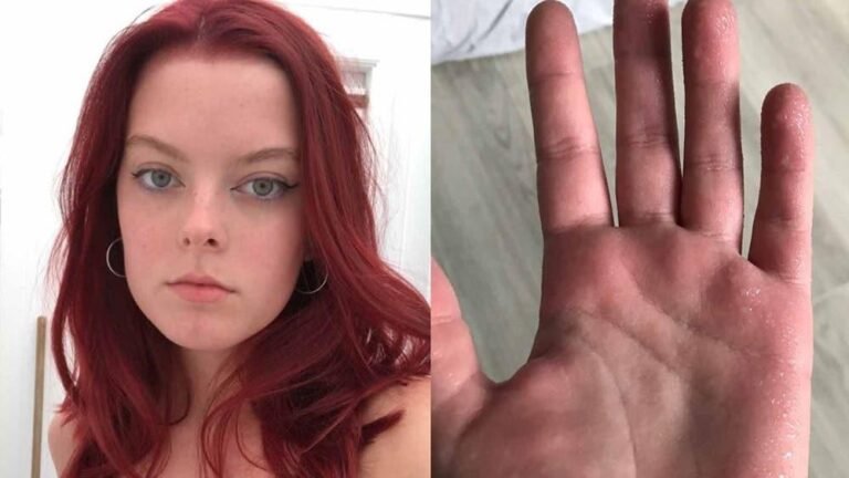 Ambitious 18 year old fundraises for Botox to stop profuse sweating that leaves her barely able to hold a pen and contributed to her quitting university