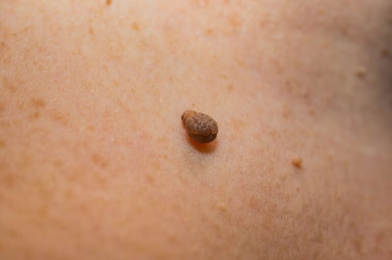 How to Remove Skin Tags Safely