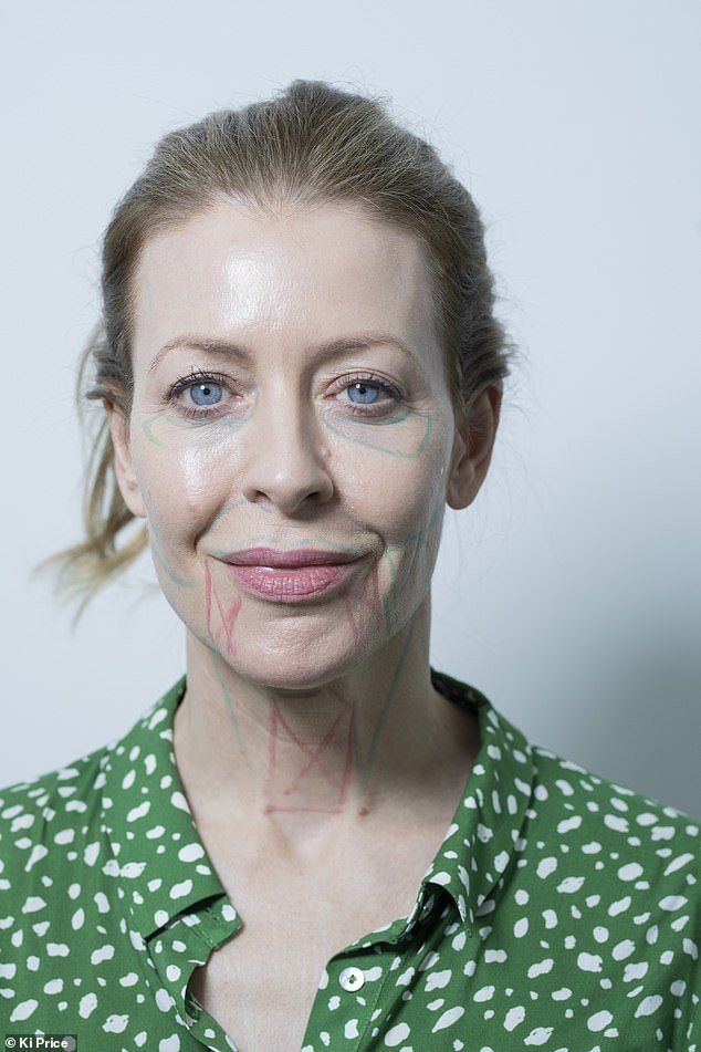 British writer Alice Hart-Davis (pictured with treatment lines on her face) has tried a new no-knife treatment that promises to regenerate skin by lasering a person's face from the inside