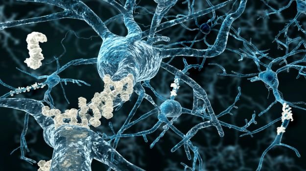 Biomarker Test Could Unlock Personalized Medicine in Alzheimer’s Disease