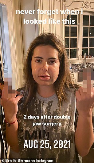 Brielle Biermann had to get her lip fillers DISSOLVED before undergoing double jaw surgery last year