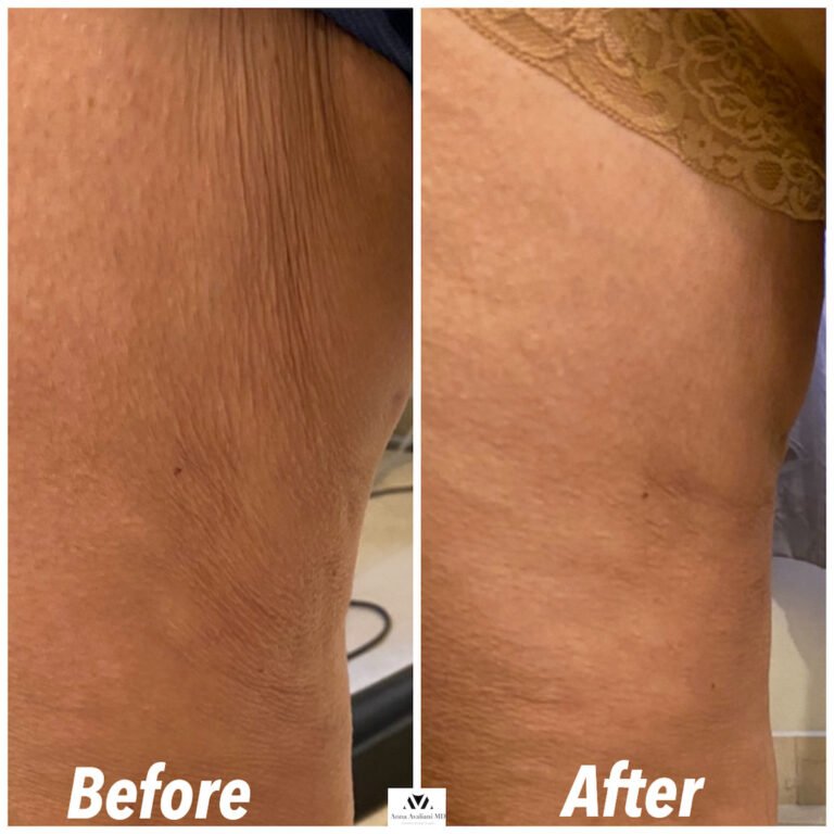 Here’s How Full Body Skin Tightening Is Possible With Sculptra