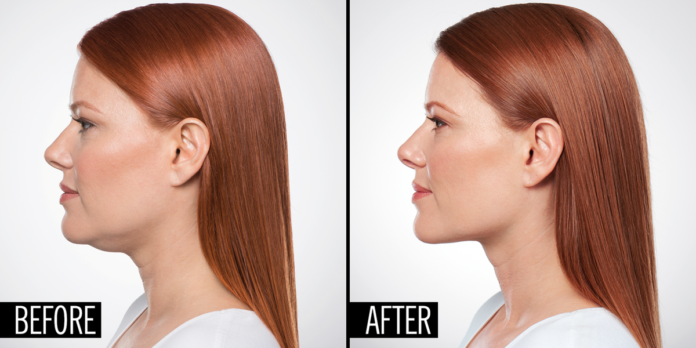 How a Plastic Surgeon Can Eliminate Your Double Chin With an Injection