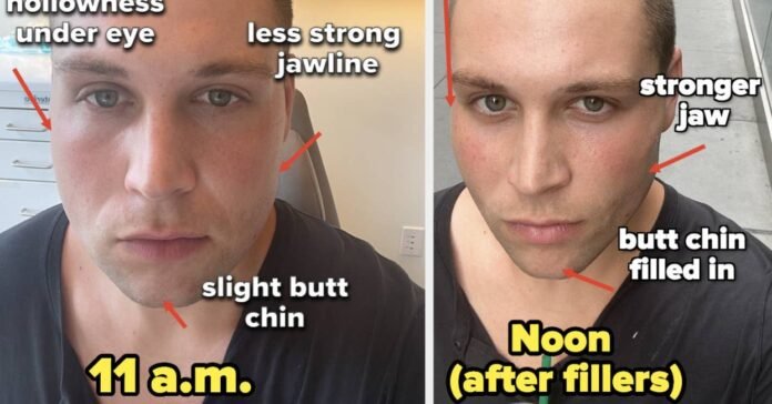 I Tried Jawline Filler And Kybella To Sculpt My Face