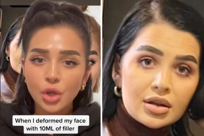 Influencer goes 'filler blind' with 10 face injections