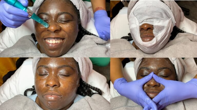Microneedling Facial Treatment | GlamByLiaLeigh