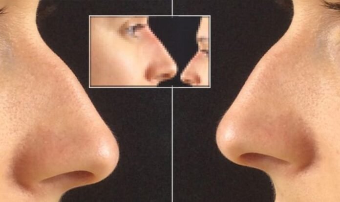 Non surgical nose job v rhinoplasty: Before after transformation pictures revealed