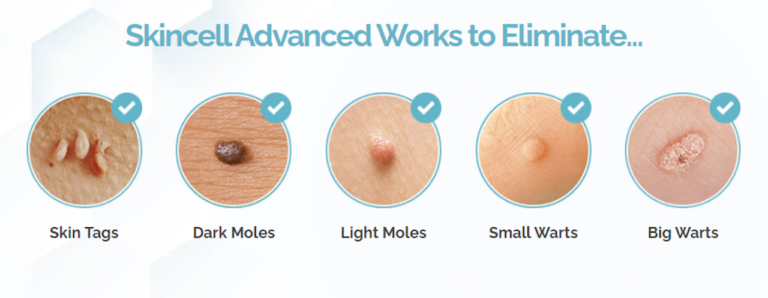 Skincell Advanced Reviews: Effective Mole & Skin Tag Removal?