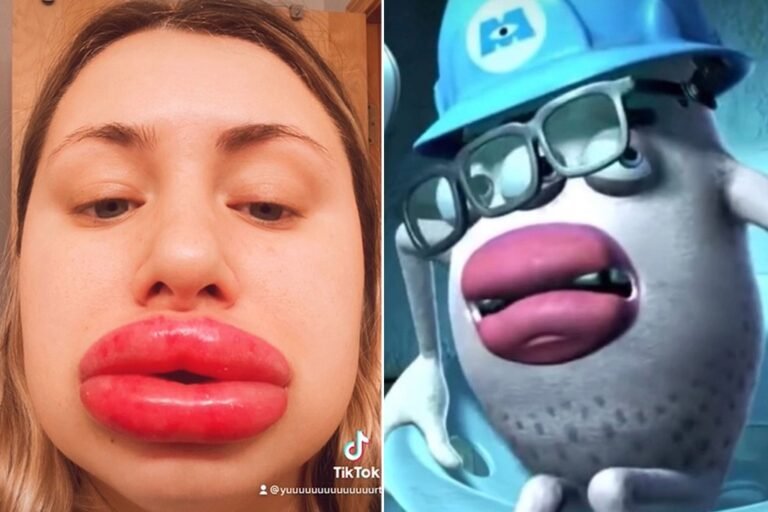 Woman claims botched fillers left her with ‘Monsters, Inc.’ lips