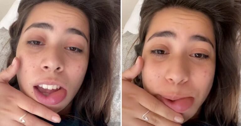 Woman jokes lip filler blunder has made her mouth balloon in size