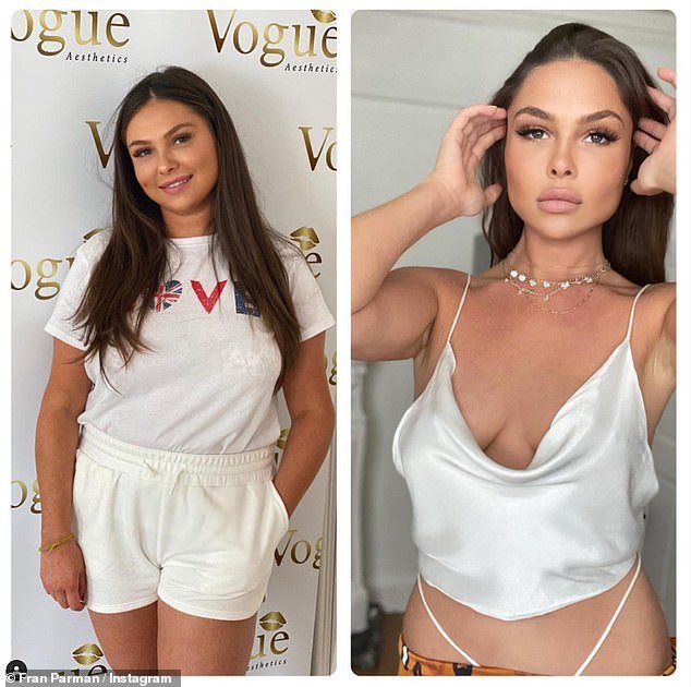 TOWIE’s Fran Parman shows off before and after face transformation after weight loss and botox