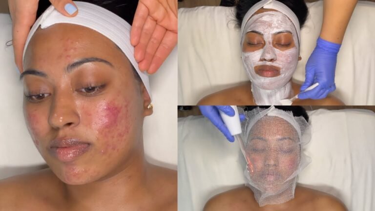 CYSTIC ACNE TREATMENT | WALK-IN FACIAL FOR GRADE 3 AND 4 ACNE  WITH PRO TIPS | LICENSED ESTHETICIAN