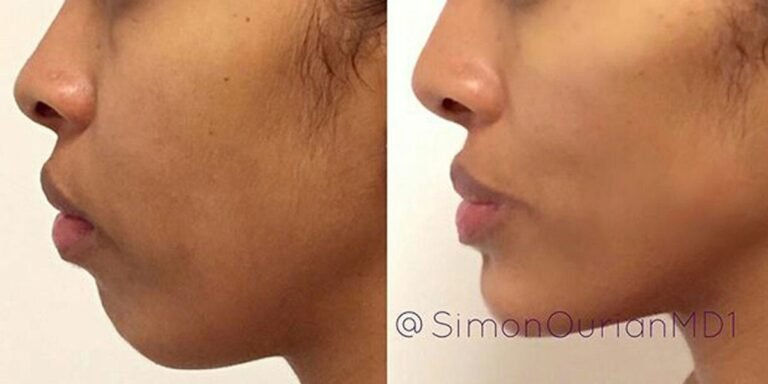 How This Plastic Surgeon Can Give You a New Chin in 5 Minutes