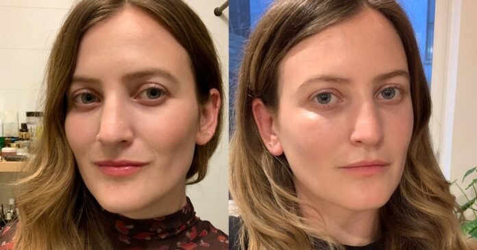 I Got Undereye Filler: See the Before and After Photos