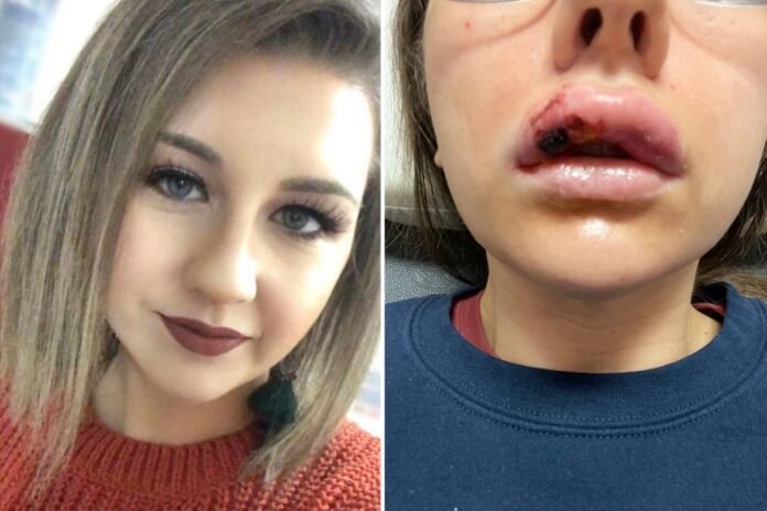 Nurse nearly loses face after botched lip service