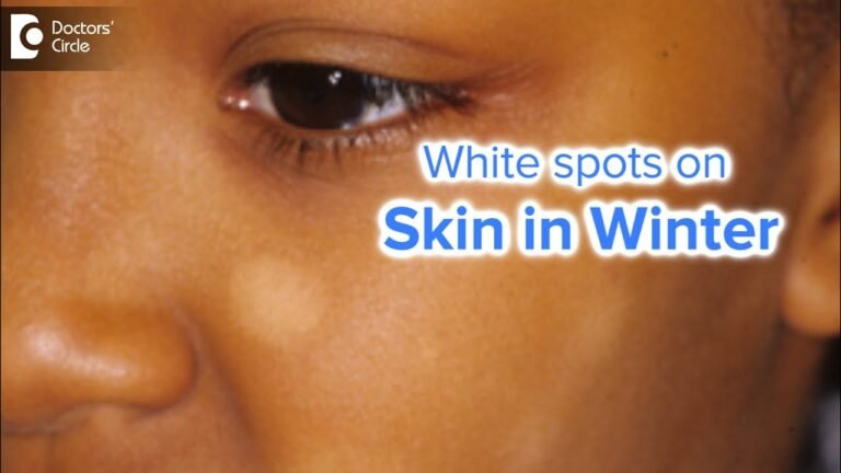 White spots on face in winter | CAUSES , PREVENTION & TREATMENT – Dr. Nischal K | Doctors' Circle