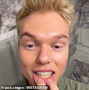 Jack Vidgen shows off his impressive smile transformation in dramatic before and after photos