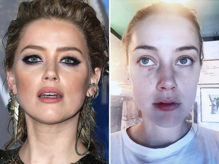 Amber Heard Botox Bruise Rumors: Cosmetic Doctor Weighs In
