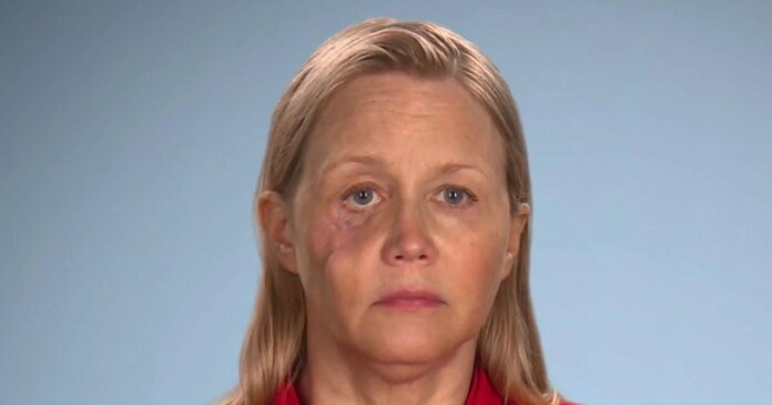 Botched Patient's Illegal Fillers Caused a Hole in Her Face - E! Online