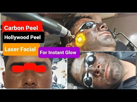 Carbon Peel-laser treatment | Hollywood Peel |Laser Facial/ Laser toning for instant glow & Radiance