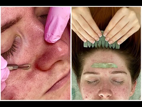 Extreme Inflamed Skin & Acne Calming Facial + Energy Healing Meditation