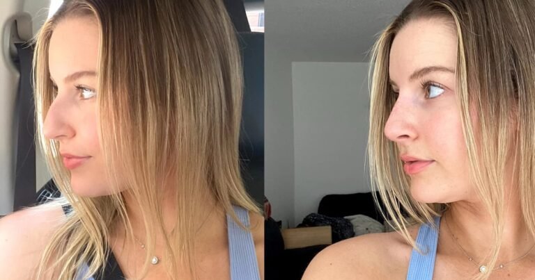 I Got a Liquid Nose Job: See Before and After Photos