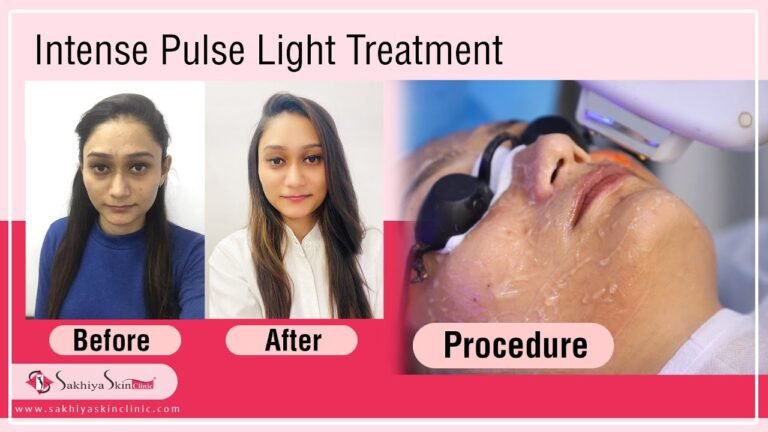 IPL Intense Pulse Light Treatment | Photo Facial  #LaserTreatment #SkinCare #SkinTreatment