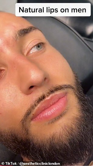 Viral video showing a man before and after getting lip filler sparks a fierce debate
