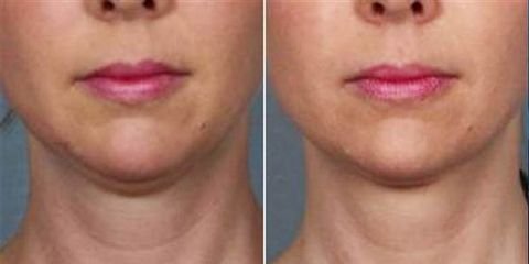 FDA Approves Injection That Removes Double Chin