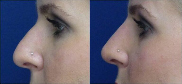 Get the Nose of Your Dreams without Surgery, Now with Permanent Results