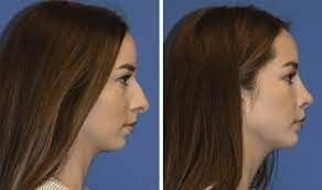 Hyaluronic acid injection a safe and viable option for chin augmentation