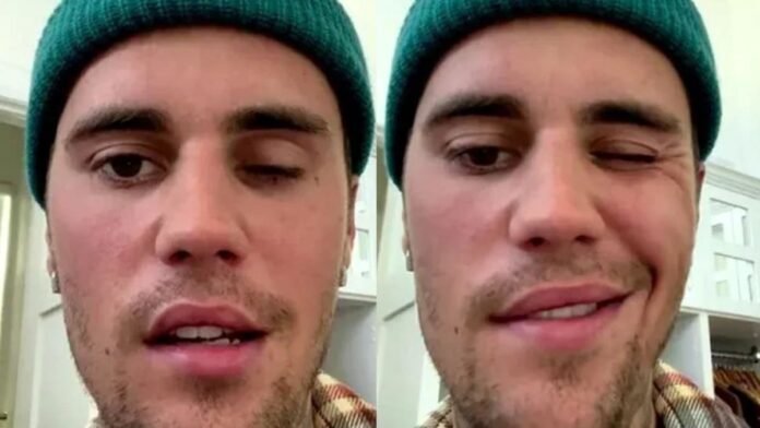 What’s the link between chickenpox and Justin Bieber’s facial paralysis? Are you at risk?
