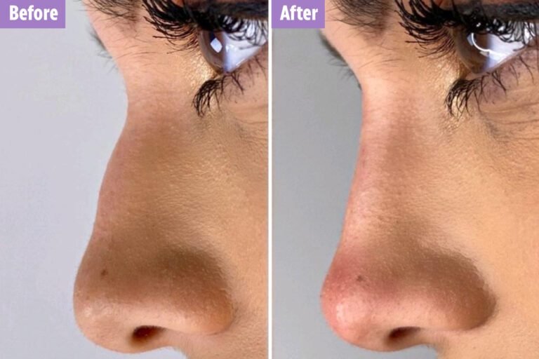 Love Island’s Ekin-Su underwent ‘nose job’ just days before show with A-lister fave Dr Motox to achieve ‘perfect curve’