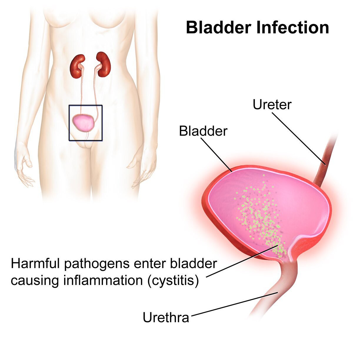 how-to-treat-painful-bladder-syndrome-your-esthetic-advisor