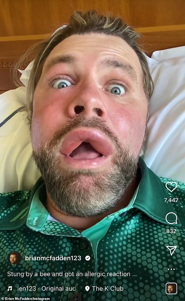 Brian McFadden looks unrecognisable after allergic reaction to bee sting