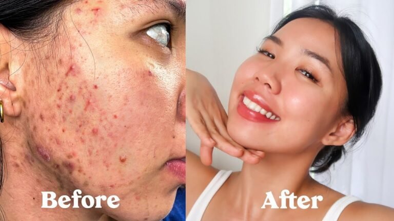(ENG SUB) HOW I GOT RID OF MY ACNE, SCARS, TEXTURE & HYPERPIGMENTATION  *not sponsored*